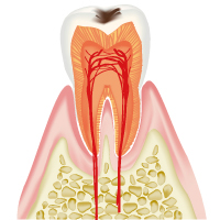 C1軽度の虫歯