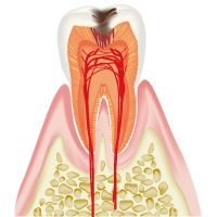 中度の虫歯C2
