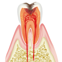 C3中度から重度の虫歯