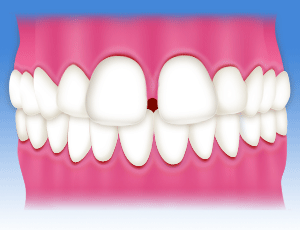 すきっ歯の場合