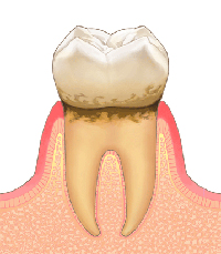 軽度の歯周炎のイラスト